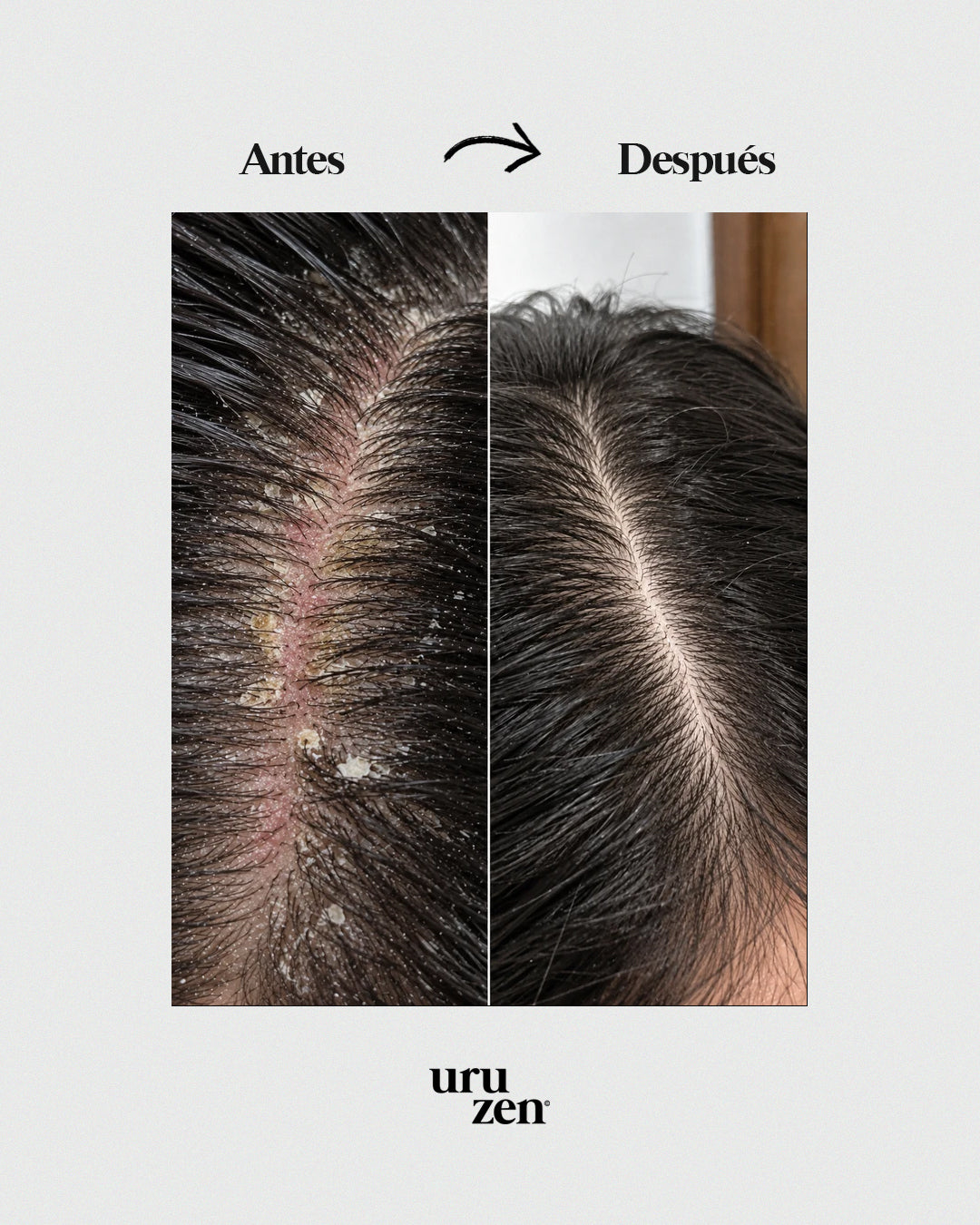 Tónico capilar contra la caspa y dermatitis seborreica