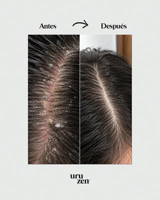 Tónico capilar contra la caspa y dermatitis seborreica