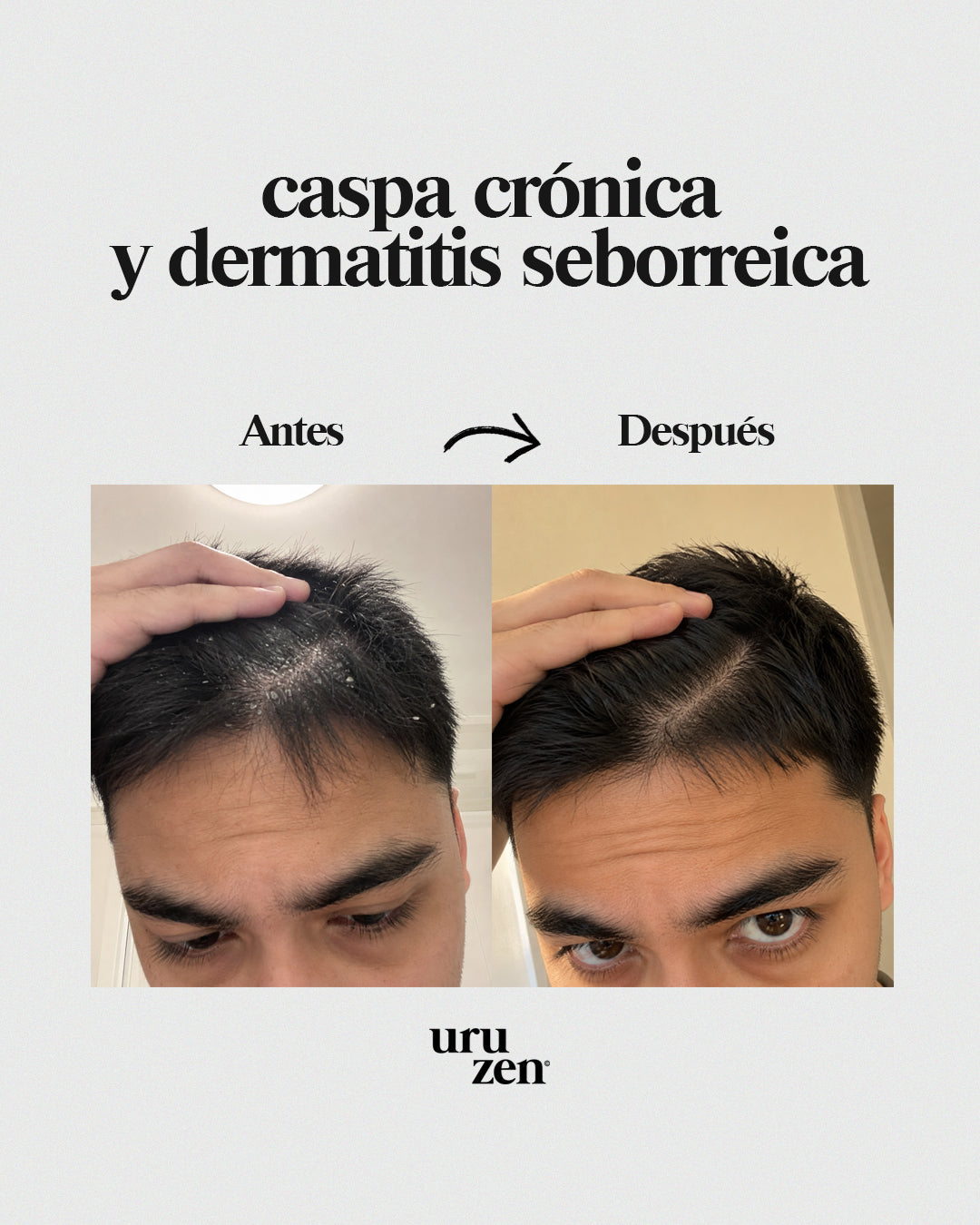 Tónico capilar contra la caspa y dermatitis seborreica