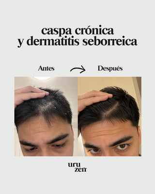 Tónico capilar contra la caspa y dermatitis seborreica