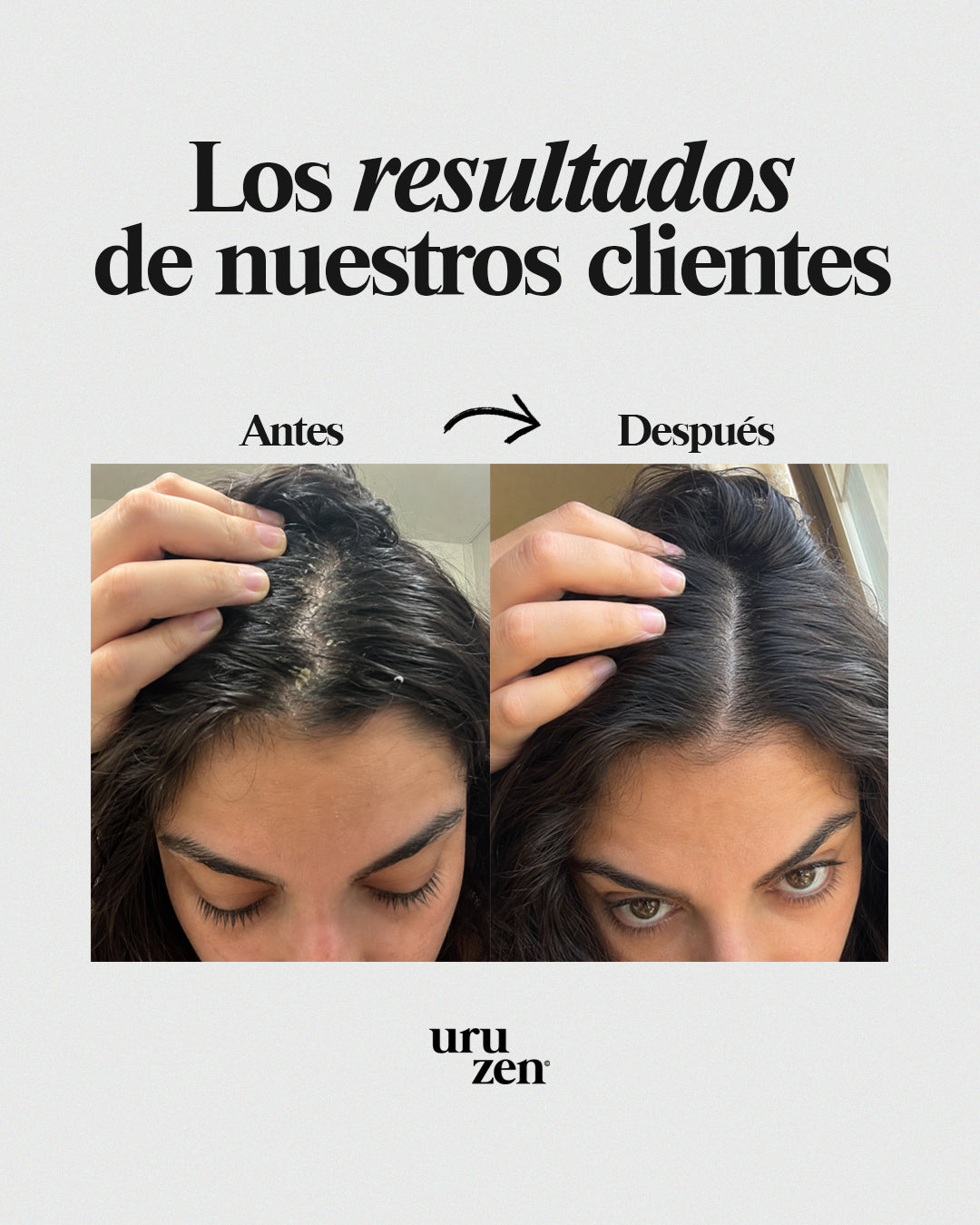 Tónico capilar contra la caspa y dermatitis seborreica